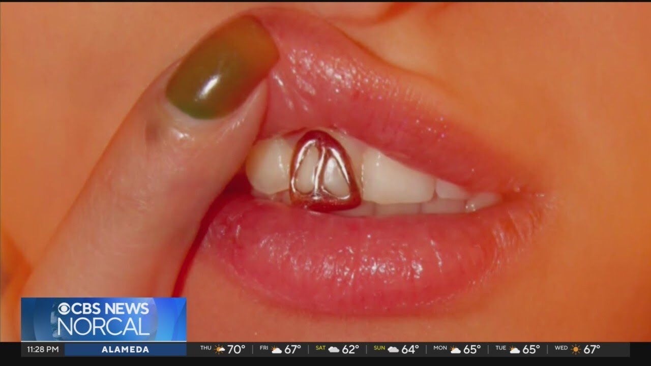 San Francisco artist turns teeth into canvas with custom grills San Francisco artist turns teeth into canvas with custom grills