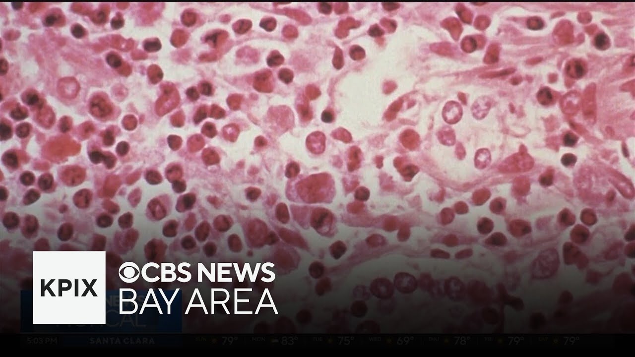 Santa Clara County resident exposed to hantavirus on cruise ship, health officials confirm Santa Clara County resident exposed to hantavirus on cruise ship, health officials confirm